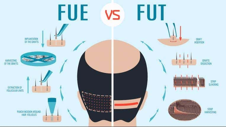 Animated image of different FUE vs FUT hair transplant