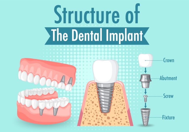 infographic on the structure of a dental implant