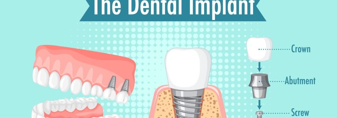 Dental Implants Turkey: Cost, Procedure and More!