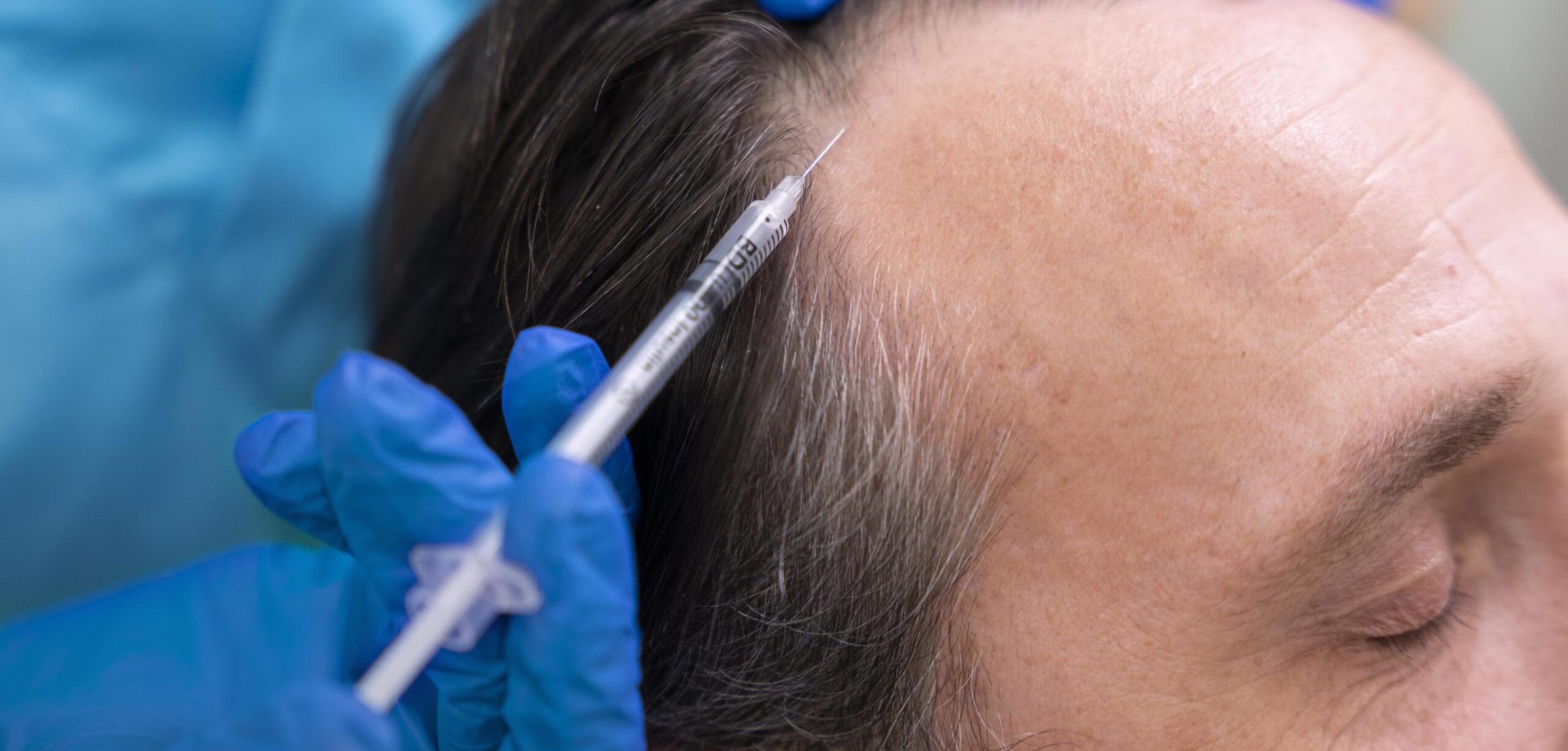 Adult male getting hair loss treatment